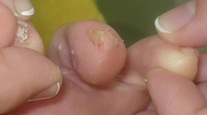 Hautmykose (Hautpilz Zwischen den Zehen)